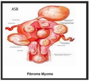 Assécher Fibrome Rapidement