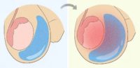 Hydrocèle Testiculaire Meilleur Remède