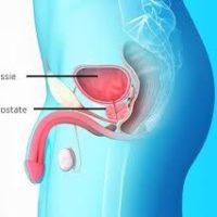 Remède Naturel Cancer de la Prostate
