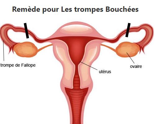 Trompes Bouchées : Voici la Recette Pour Soigner les Trompes Bouchées