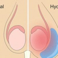 Hydrocèle Vaginale Remède Naturel