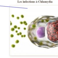 Infection de Chlamydia Traitement Naturel