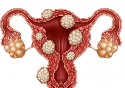 Éliminer Les Myomes Naturellement