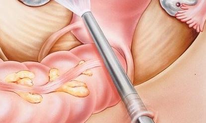 Trompes Bouchées : Comment Débloquer les Trompes Bouchées Naturellement