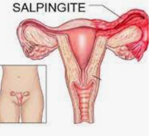 Guérir La Salpingite Naturellement