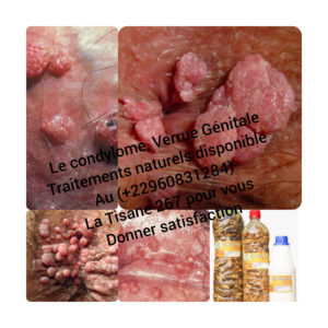 Condylomes Verrues Traitement Naturel