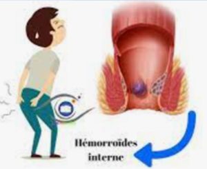 Soigner Hémorroïdes Naturellement