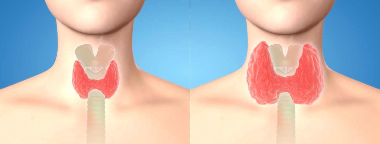 Guérir La Thyroïdie Naturellement