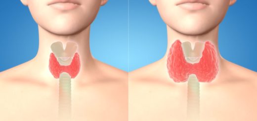 Guérir La Thyroïdie Naturellement