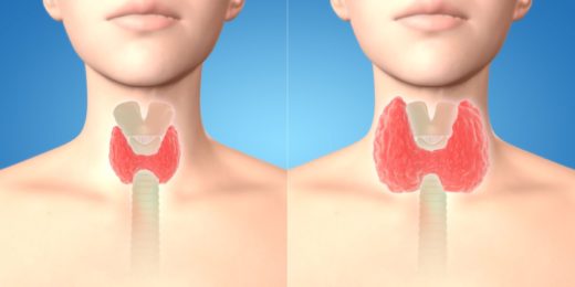 Guérir La Thyroïdie Naturellement