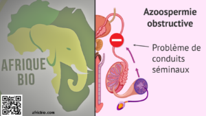 Azoospermie Symptômes Traitement Naturel - Azoospermie obstructive