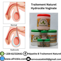 Traitement Naturel Hydrocèle Vaginale