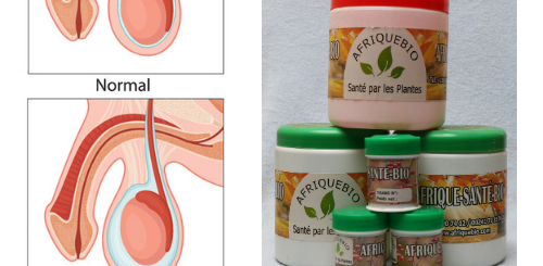 Traitement Naturel Hydrocèle Vaginale