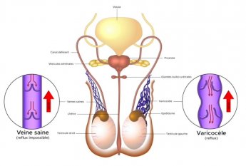 Varicocèle Grade 2 Traitement Naturel